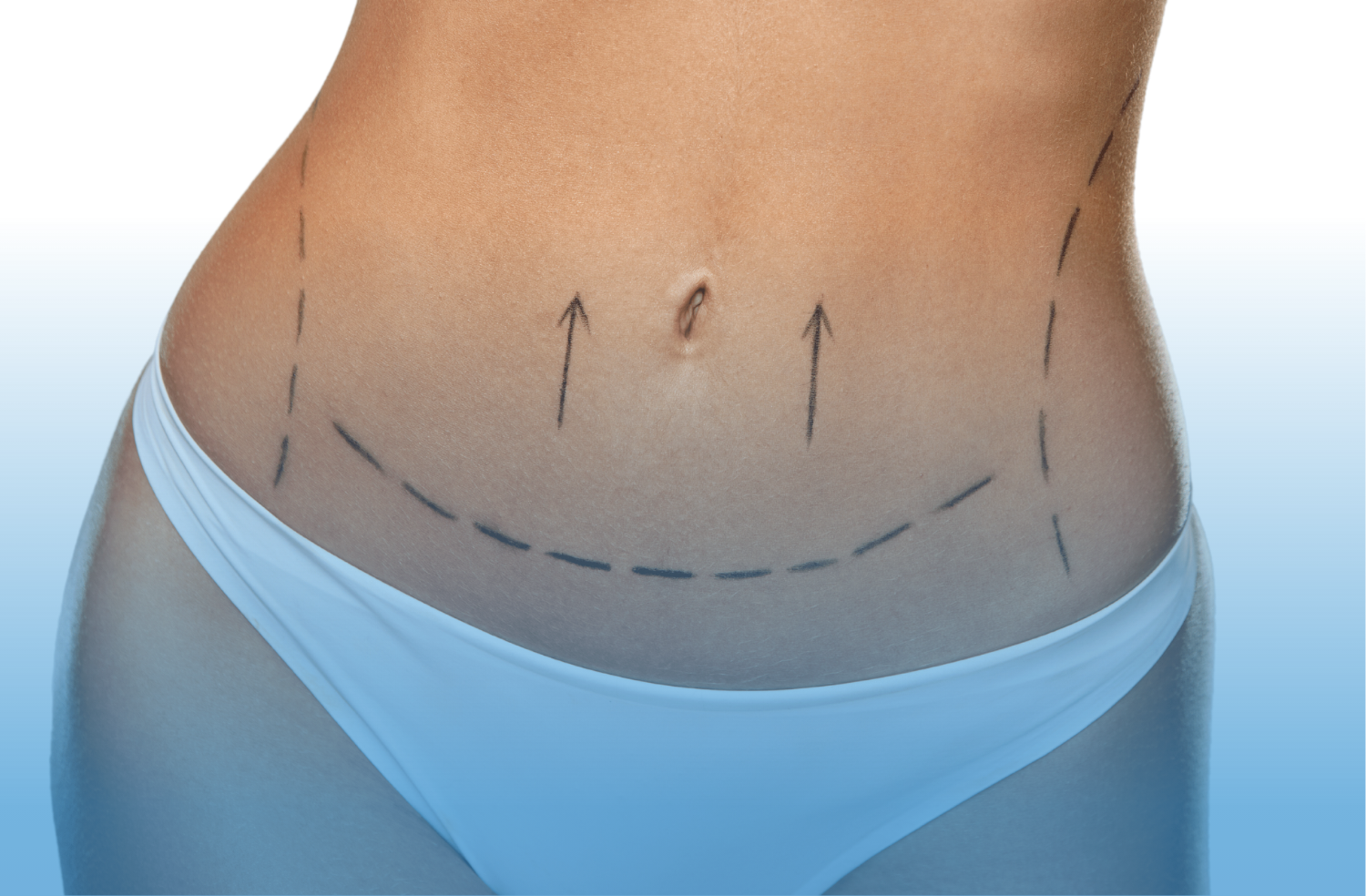 abdominoplastia-2