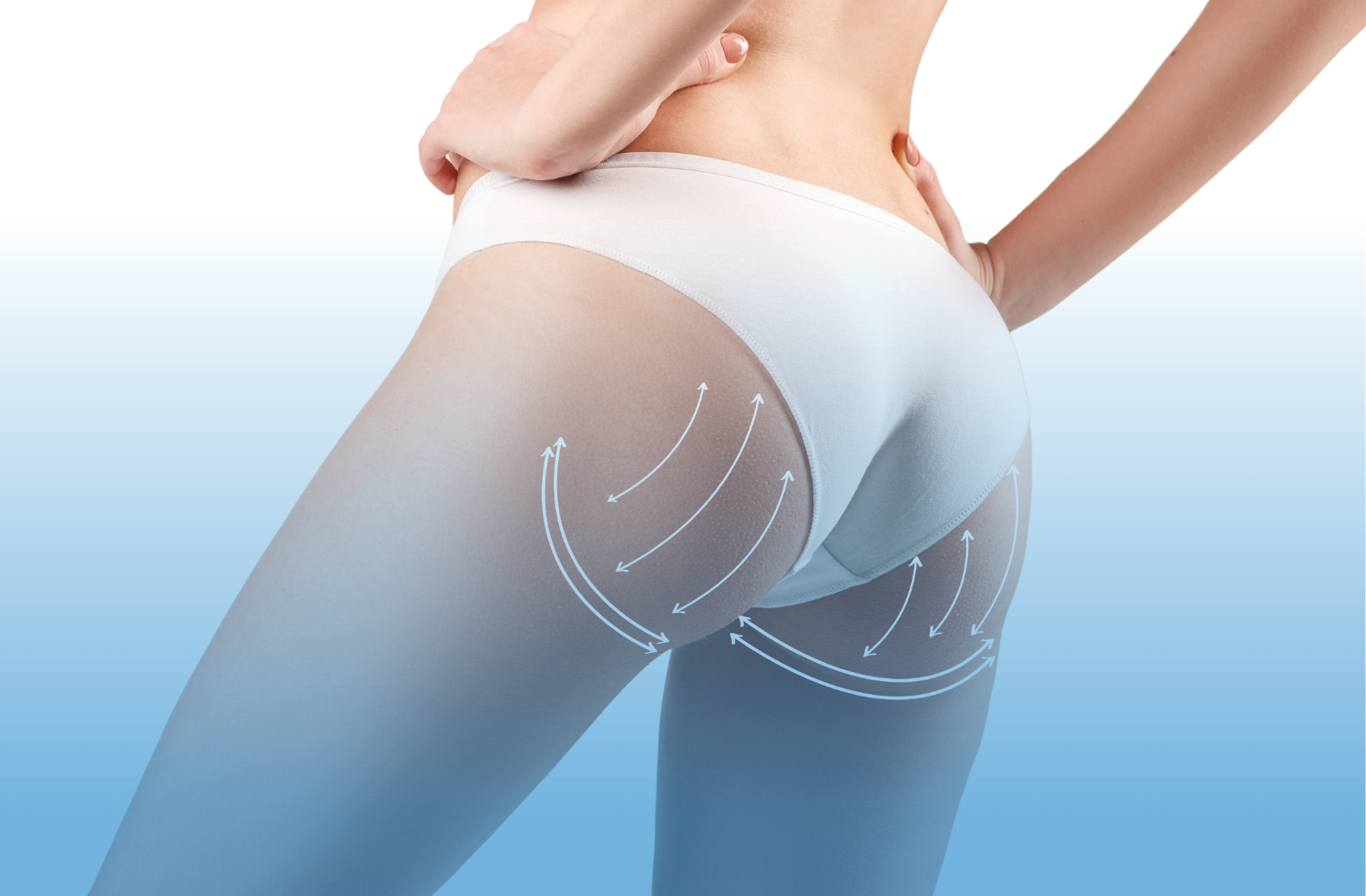 gluteoplastia