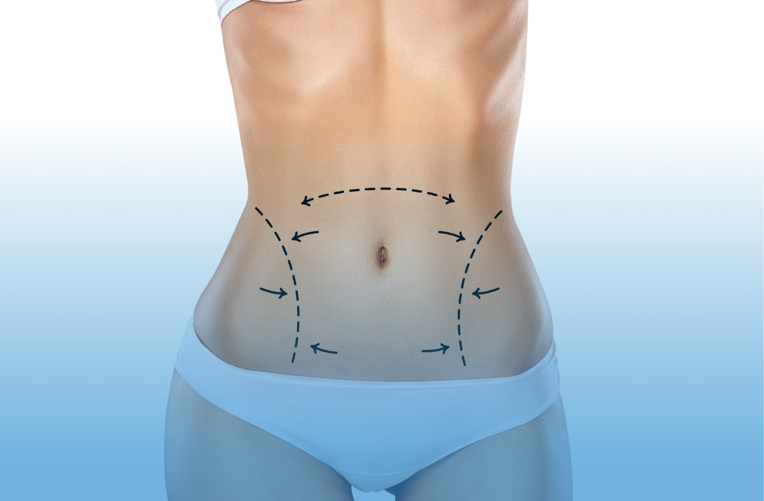 Lipoabdominoplastia1